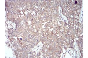 Immunohistochemical analysis of paraffin-embedded bladder cancer tissues using NOX4 mouse mAb with DAB staining. (NADPH Oxidase 4 antibody  (AA 210-310))