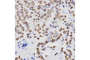 Immunohistochemistry of paraffin-embedded human thyroid cancer using DiMethyl-Histone H4-K20 antibody. (Histone H4 antibody  (2meLys20))