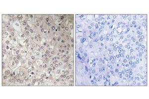 Immunohistochemistry analysis of paraffin-embedded human liver carcinoma tissue using GIPR antibody.