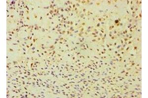 Immunohistochemistry of paraffin-embedded human breast cancer using ABIN7144295 at dilution of 1:100 (ANXA8L2 antibody  (AA 1-276))
