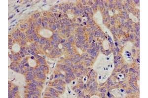 Immunohistochemistry of paraffin-embedded human colon cancer using ABIN7169599 at dilution of 1:100