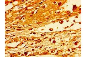 Immunohistochemistry of paraffin-embedded human melanoma using ABIN7171253 at dilution of 1:100 (STXBP1 antibody  (AA 245-594))