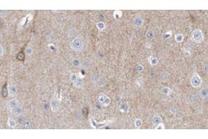 ABIN6278328 at 1/100 staining Human brain cancer tissue by IHC-P.