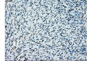 Immunohistochemical staining of paraffin-embedded Adenocarcinoma of breast tissue using anti-PRKY mouse monoclonal antibody. (PRKY antibody)