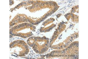 Immunohistochemistry of Human lung cancer using MDK Polyclonal Antibody at dilution of 1:60 (Midkine antibody)
