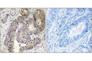 Immunohistochemistry analysis of paraffin-embedded human colon carcinoma, using CAD (Phospho-Thr456) Antibody.