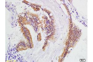 Formalin-fixed and paraffin embedded human colon carcinoma labeled with Anti-IEX1/Differentiation Dependent Gene 2 protein Polyclonal Antibody, Unconjugated (ABIN872466) at 1:200 followed by conjugation to the secondary antibody and DAB staining (IER3 antibody  (AA 85-156))