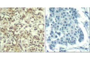 Immunohistochemical analysis of paraffin-embedded human breast carcinoma tissue using AKT1 (phospho- Thr450) Antibody (E011502). (AKT1 antibody  (pThr450))