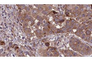 ABIN6277679 at 1/100 staining Human liver cancer tissue by IHC-P. (Serotonin Receptor 3A antibody  (Internal Region))
