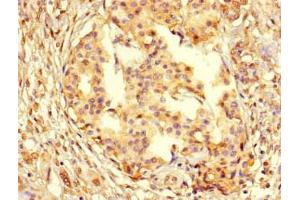Immunohistochemistry of paraffin-embedded human pancreatic cancer using ABIN7164738 at dilution of 1:100 (PCNA antibody  (AA 1-261))