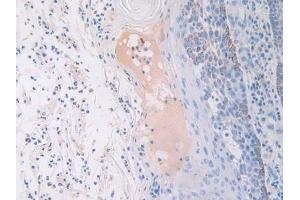 Detection of FGFR3 in Human Skin cancer Tissue using Polyclonal Antibody to Fibroblast Growth Factor Receptor 3 (FGFR3) (FGFR3 antibody  (AA 166-375))