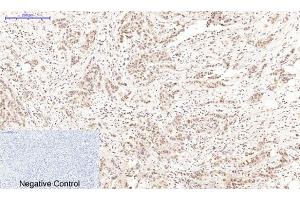 Immunohistochemical analysis of paraffin-embedded human breast cancer tissue. (PARP1 antibody  (cleaved))
