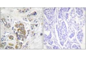 Immunohistochemistry analysis of paraffin-embedded human breast carcinoma, using ITGB4 (Phospho-Tyr1510) Antibody. (Integrin beta 4 antibody  (pTyr1510))