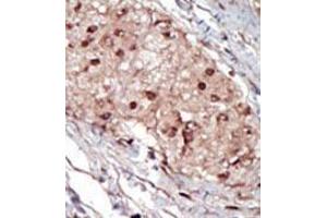 Formalin-fixed and paraffin-embedded human cancer tissue (hepatocarcinoma) reacted with the primary antibody, which was peroxidase-conjugated to the secondary antibody, followed by AEC staining.