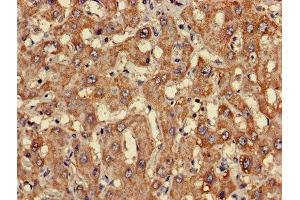 Immunohistochemistry of paraffin-embedded human liver cancer using ABIN7147936 at dilution of 1:100 (CLASP2 antibody  (AA 226-381))