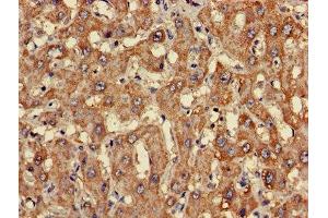 Immunohistochemistry of paraffin-embedded human liver cancer using ABIN7147936 at dilution of 1:100 (CLASP2 antibody  (AA 226-381))