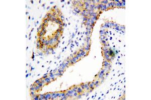 Anti-BCAT1 antibody, IHC(P) IHC(P): Human Mammary Cancer Tissue (BCAT1 antibody  (C-Term))