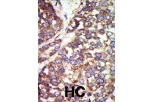 Formalin-fixed and paraffin-embedded human cancer tissue reacted with the primary antibody, which was peroxidase-conjugated to the secondary antibody, followed by DAB staining. (PAK2 antibody  (N-Term))