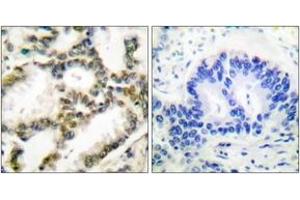 Immunohistochemistry analysis of paraffin-embedded human lung carcinoma tissue, using DJ-1 Antibody. (PARK7/DJ1 antibody  (AA 21-70))