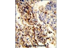 Formalin-fixed and paraffin-embedded human lung carcinoma reacted with CXorf22 Antibody (Center), which was peroxidase-conjugated to the secondary antibody, followed by DAB staining. (CXorf22 antibody  (AA 628-657))