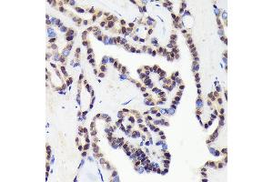 Immunohistochemistry of paraffin-embedded human thyroid cancer using CDC Rabbit mAb (ABIN1682192, ABIN3018455, ABIN3018456 and ABIN7101613) at dilution of 1:100 (40x lens). (CDCA5 antibody)
