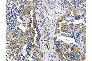 ABIN6257319 and ABIN6276046 at 1/100 staining Human lung cancer by IHC-P. (MC4R antibody  (C-Term))