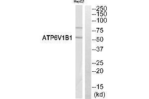 Immunohistochemistry analysis of paraffin-embedded human breast carcinoma tissue, using ATP6V1B1 antibody. (ATP6V1B1 antibody  (C-Term))