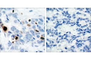 P-Peptide - +Immunohistochemical analysis of paraffin-embedded human breast carcinoma tissue using Histone H3. (Histone H3.1 antibody  (pSer10))