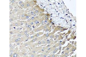 Immunohistochemistry of paraffin-embedded Human liver damage using MGAT1 Polyclonal Antibody at dilution of 1:100 (40x lens). (MGAT1 antibody)