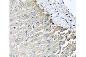 Immunohistochemistry of paraffin-embedded Human liver damage using MGAT1 Polyclonal Antibody at dilution of 1:100 (40x lens).