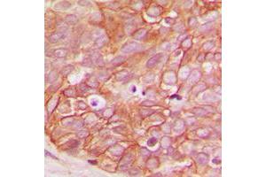 Immunohistochemical analysis of Beta-catenin (pS33) staining in human breast cancer formalin fixed paraffin embedded tissue section. (beta Catenin antibody  (N-Term, pSer33))
