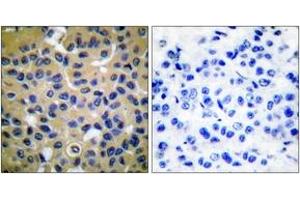 Immunohistochemistry analysis of paraffin-embedded human breast carcinoma tissue, using Collagen II Antibody. (COL2 antibody  (AA 101-150))