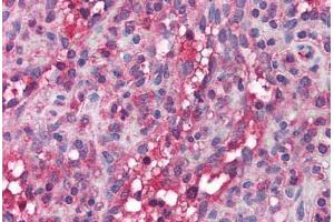 Immunohistochemistry (Paraffin-embedded Sections) (IHC (p)) image for anti-Apolipoprotein B mRNA Editing Enzyme, Catalytic Polypeptide-Like 3G (APOBEC3G) (AA 51-100) antibody (ABIN6736355)