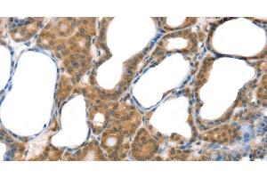 Immunohistochemistry of paraffin-embedded Human thyroid cancer tissue using Laminin alpha4 Polyclonal Antibody at dilution 1:30 (LAMa4 antibody)