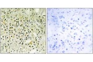 Immunohistochemistry analysis of paraffin-embedded human prostate carcinoma tissue, using LEG8 Antibody. (LGALS8 antibody  (AA 61-110))