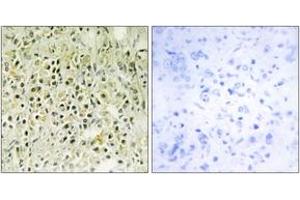 Immunohistochemistry analysis of paraffin-embedded human prostate carcinoma tissue, using LEG8 Antibody.