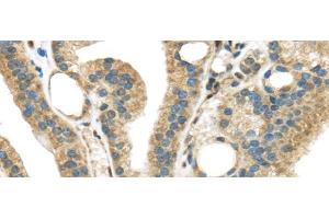 Immunohistochemistry of paraffin-embedded Human thyroid cancer tissue using STK35 Polyclonal Antibody at dilution 1:45 (STK35 antibody)