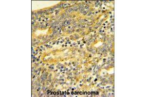DPP8 Antibody IHC analysis in formalin fixed and paraffin embedded human Prostate carcinoma followed by peroxidase conjugation of the secondary antibody and DAB staining. (DPP8 antibody  (C-Term))