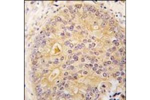 Formalin-fixed and paraffin-embedded human prostata carcinoma tissue reacted with CAMKK2 antibody (N-term), which was peroxidase-conjugated to the secondary antibody, followed by DAB staining. (CAMKK2 antibody  (N-Term))