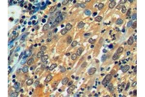IHC-P analysis of Human Endometrial cancer Tissue, with DAB staining. (HSPA1L antibody  (AA 1-641))