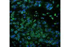 IHC testing of FFPE human lung cancer tissue with Emerin antibody at 1ug/ml. (Emerin antibody  (AA 1-48))