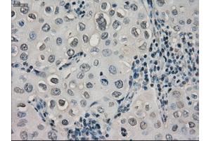 Immunohistochemical staining of paraffin-embedded Adenocarcinoma of ovary tissue using anti-CRYABmouse monoclonal antibody. (CRYAB antibody)