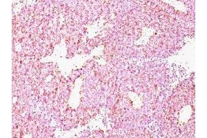 Formalin-paraffin human SC lung carcinoma stained with Chromogranin A antibody (CHGA/798)