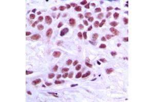 Immunohistochemical analysis of TRAP220 staining in human breast cancer formalin fixed paraffin embedded tissue section. (MED1 antibody  (Center))