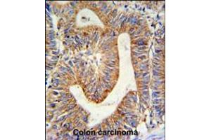 RPL17 Antibody IHC analysis in formalin fixed and paraffin embedded colon carcinoma followed by peroxidase conjugation of the secondary antibody and DAB staining. (RPL17 antibody  (C-Term))