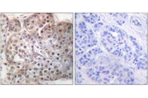 Immunohistochemistry analysis of paraffin-embedded human breast carcinoma, using STAT5A/B (Phospho-Ser725/730) Antibody. (STAT5 A/B antibody  (pSer726))