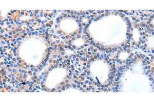 Immunohistochemistry of paraffin-embedded Human thyroid cancer using HCN1 Polyclonal Antibody at dilution of 1:50 (HCN1 antibody)