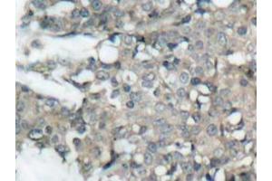 Immunohistochemistry analyzes of MEK1/2 antibody in paraffin-embedded human breast carcinoma tissue. (MEK1 antibody)