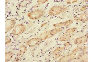 Immunohistochemistry of paraffin-embedded human gastric cancer using ABIN7166195 at dilution of 1:100 (TOB2 antibody  (AA 1-70))