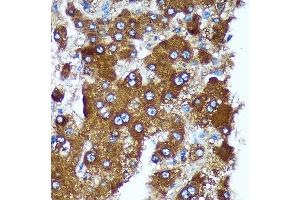 Immunohistochemistry of paraffin-embedded Human liver cancer using PIGU Rabbit pAb (ABIN7269291) at dilution of 1:100 (40x lens). (PIGU antibody)